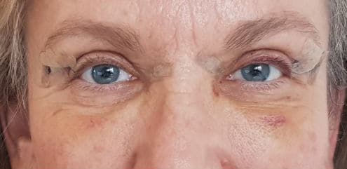 Blepharoplasty vs brow lift