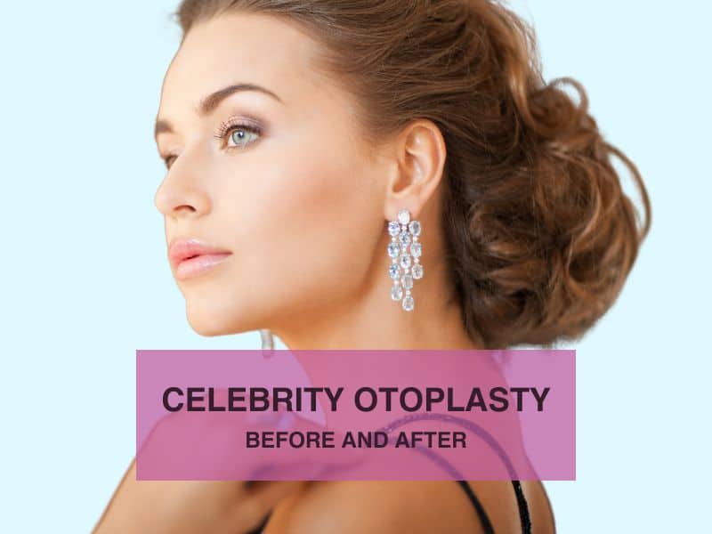 CELEBRITY OTOPLASTY BEFORE AND AFTER