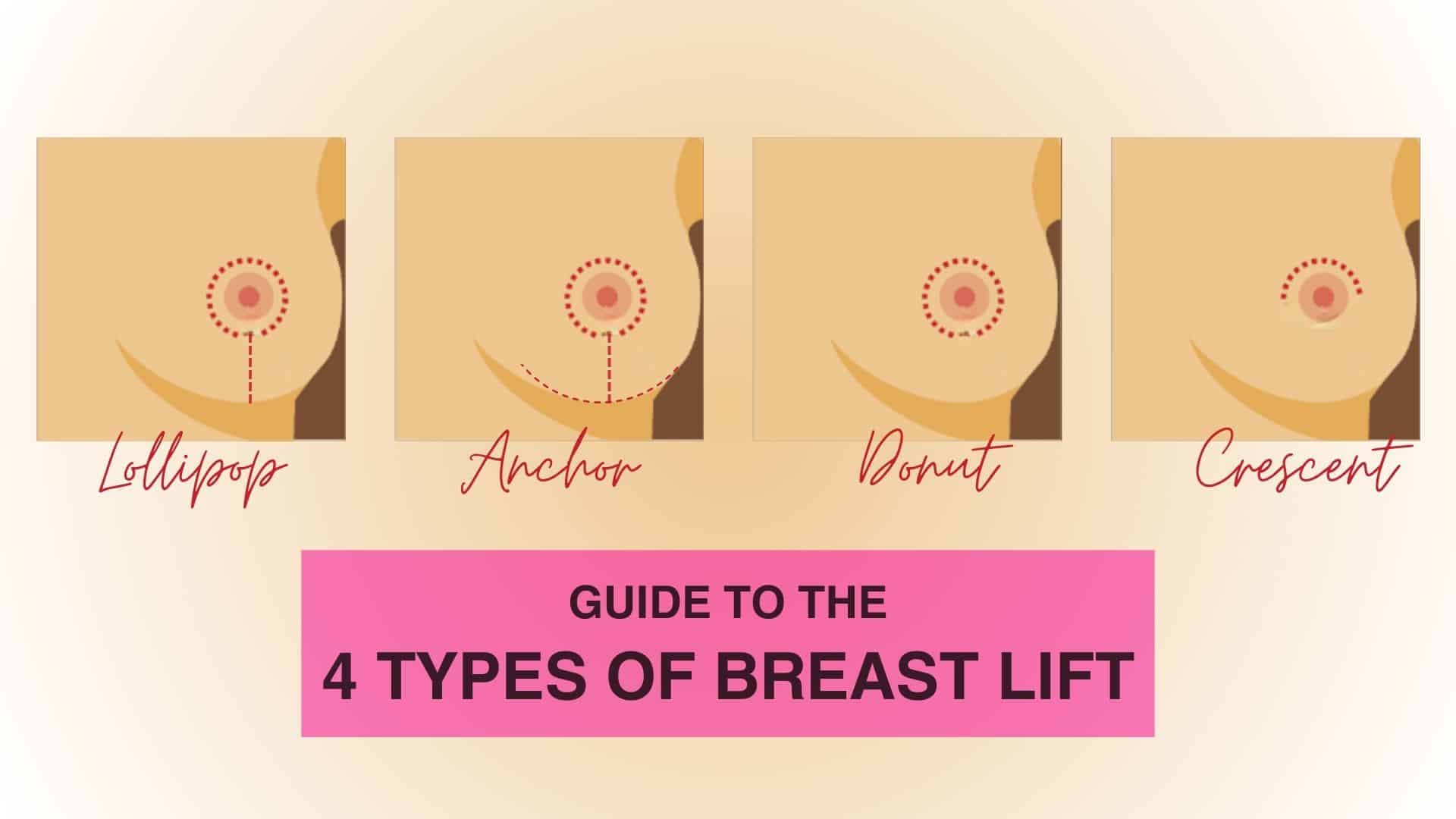 Guide to the 4 Types of Breast Lifts