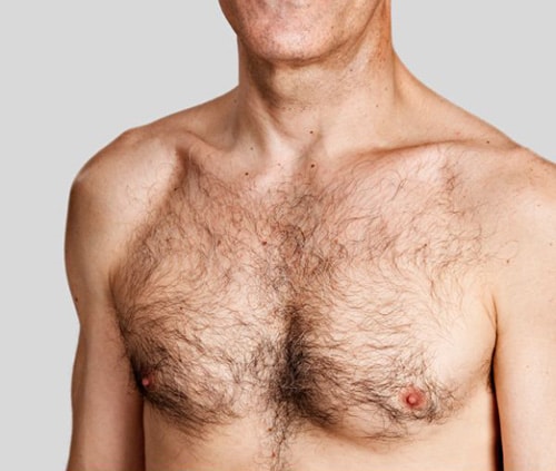 Is male gynecomastia reversible