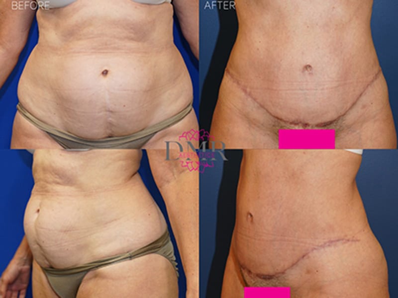 Tummy Tuck Chicago Before and After
