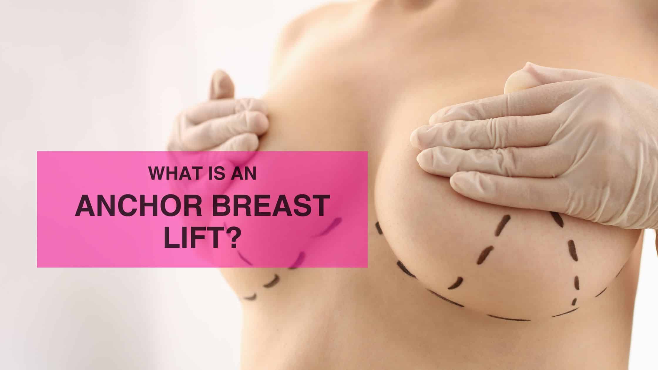 What Is an Anchor Breast Lift