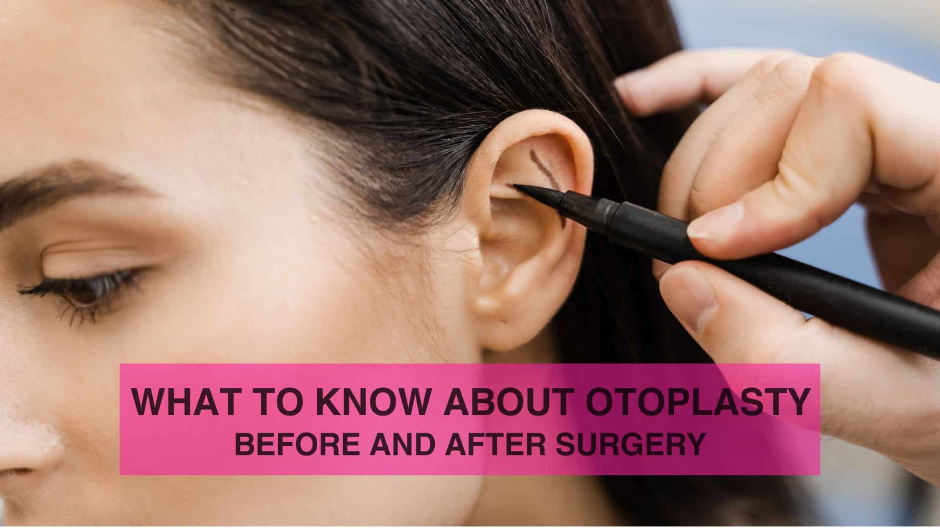 What to Know About Otoplasty Before and After Surgery