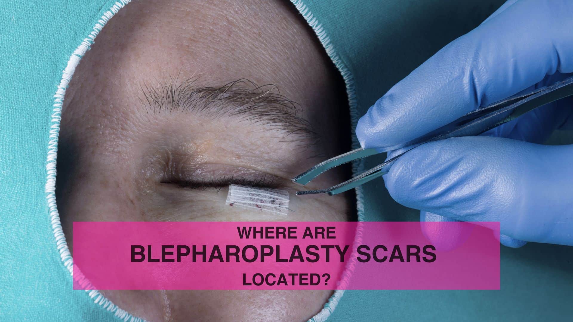 Where Are Blepharoplasty Scars Located