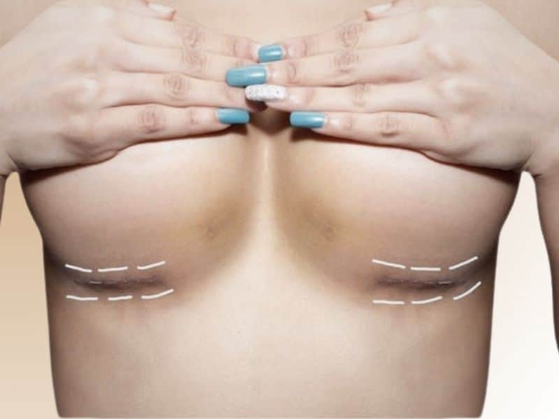 Breast augmentation fat transfer scars