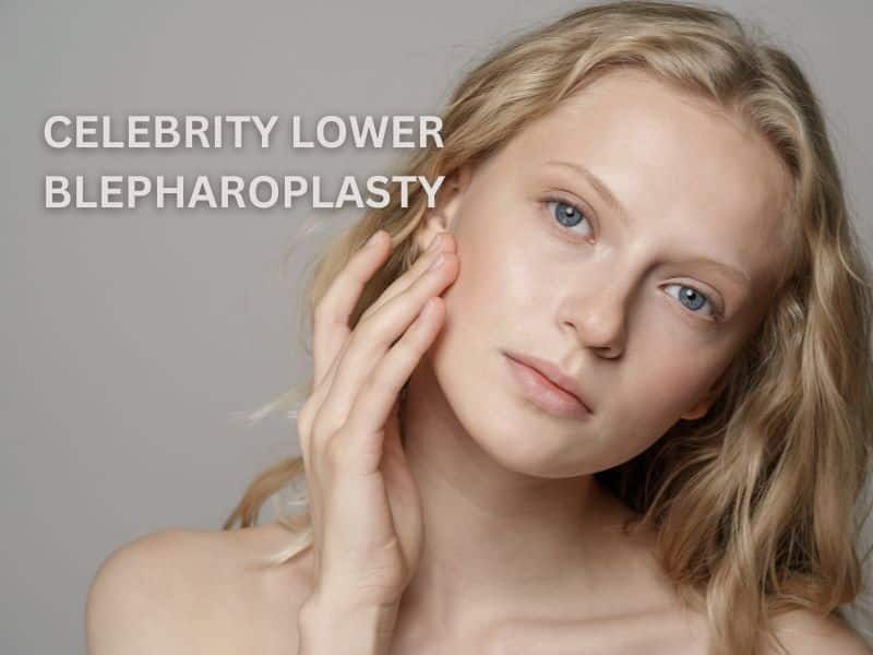 celebrity lower blepharoplasty