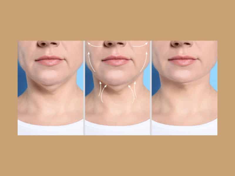 chin liposuction recovery day by day 