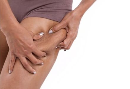 does liposuction work for cellulite