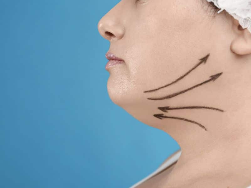 double chin liposuction scar