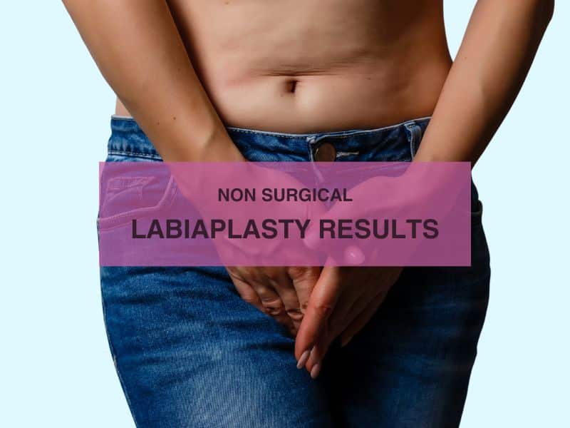 non surgical labiaplasty results