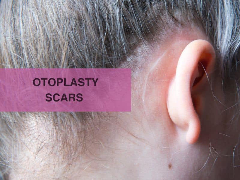 otoplasty scars pictures