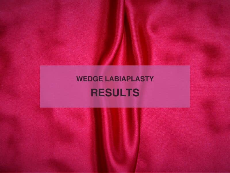 wedge labiaplasty results